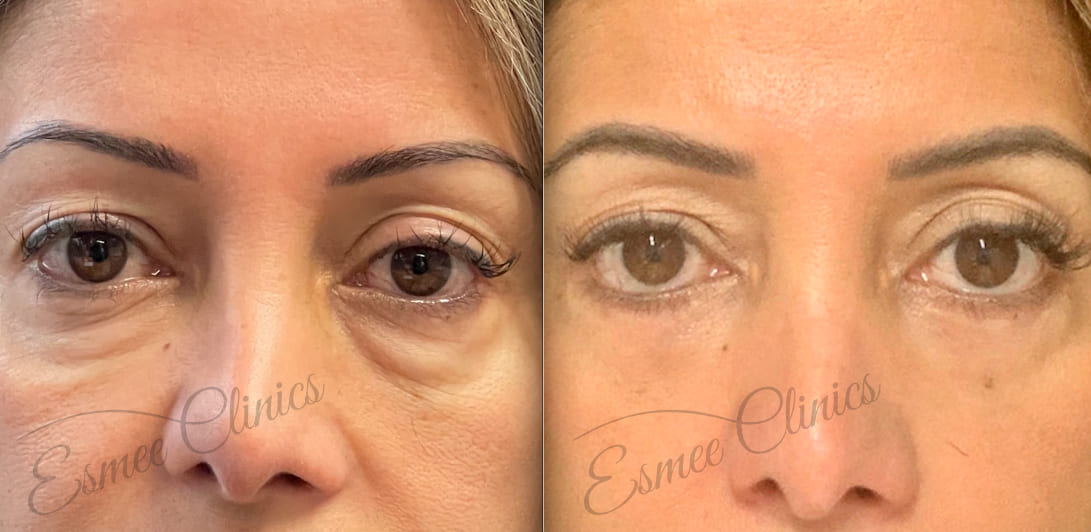 Before and After img